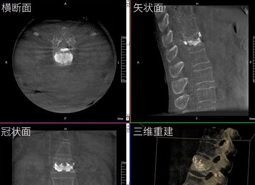 三維C形臂與二維C形臂臨床圖像實(shí)時(shí)對比